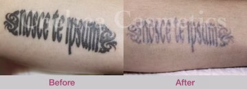 Laser Tattoo Removal