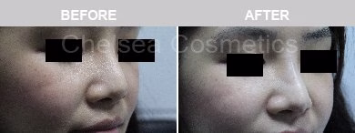 Non-Surgical Rhinoplasty