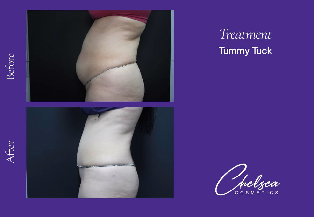 Tummy Tuck (Abdominoplasty) — Chelsea Cosmetics Melbourne