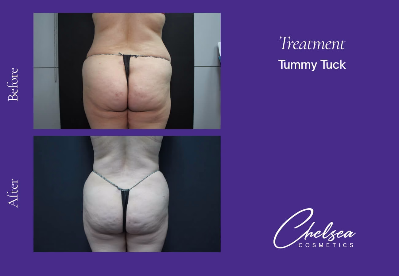 Tummy Tuck (Abdominoplasty) — Chelsea Cosmetics Melbourne