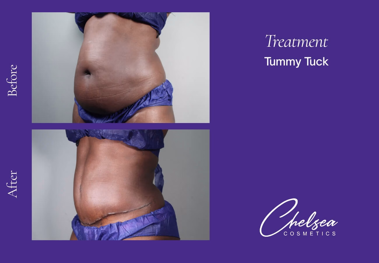 Tummy Tuck (Abdominoplasty) — Chelsea Cosmetics Melbourne