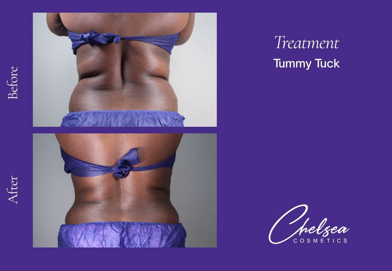 Tummy Tuck (Abdominoplasty) — Chelsea Cosmetics Melbourne