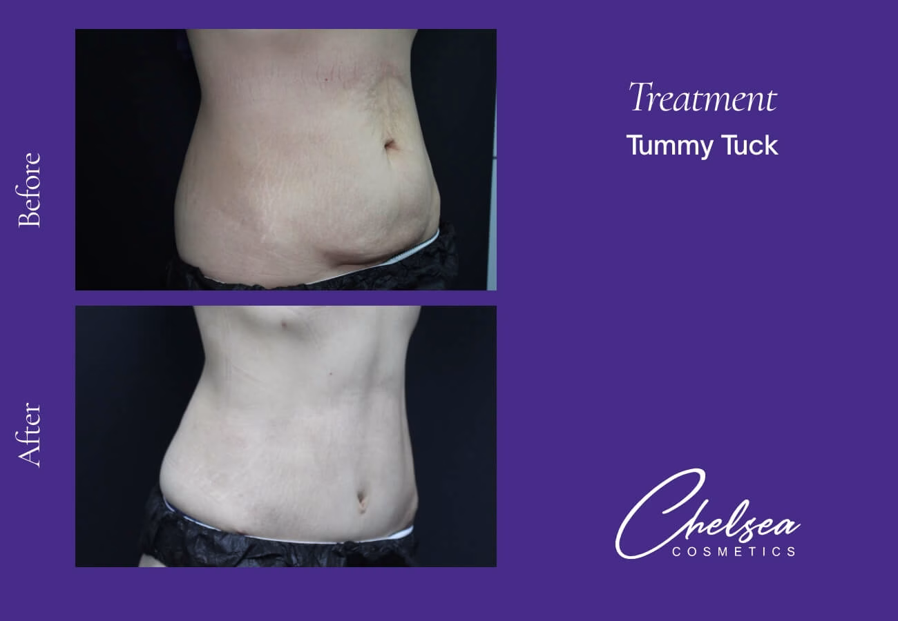 Tummy Tuck (Abdominoplasty) — Chelsea Cosmetics Melbourne