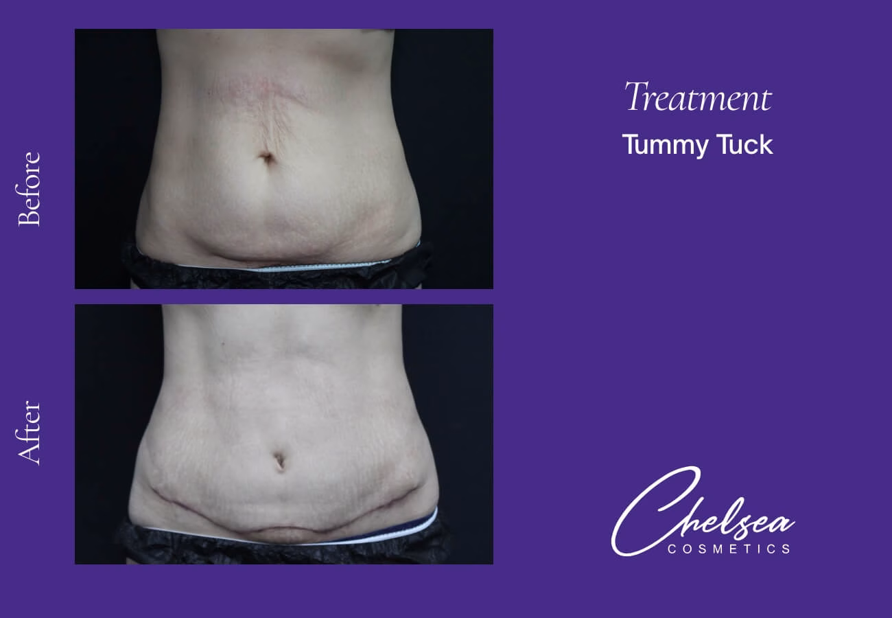Tummy Tuck (Abdominoplasty) — Chelsea Cosmetics Melbourne