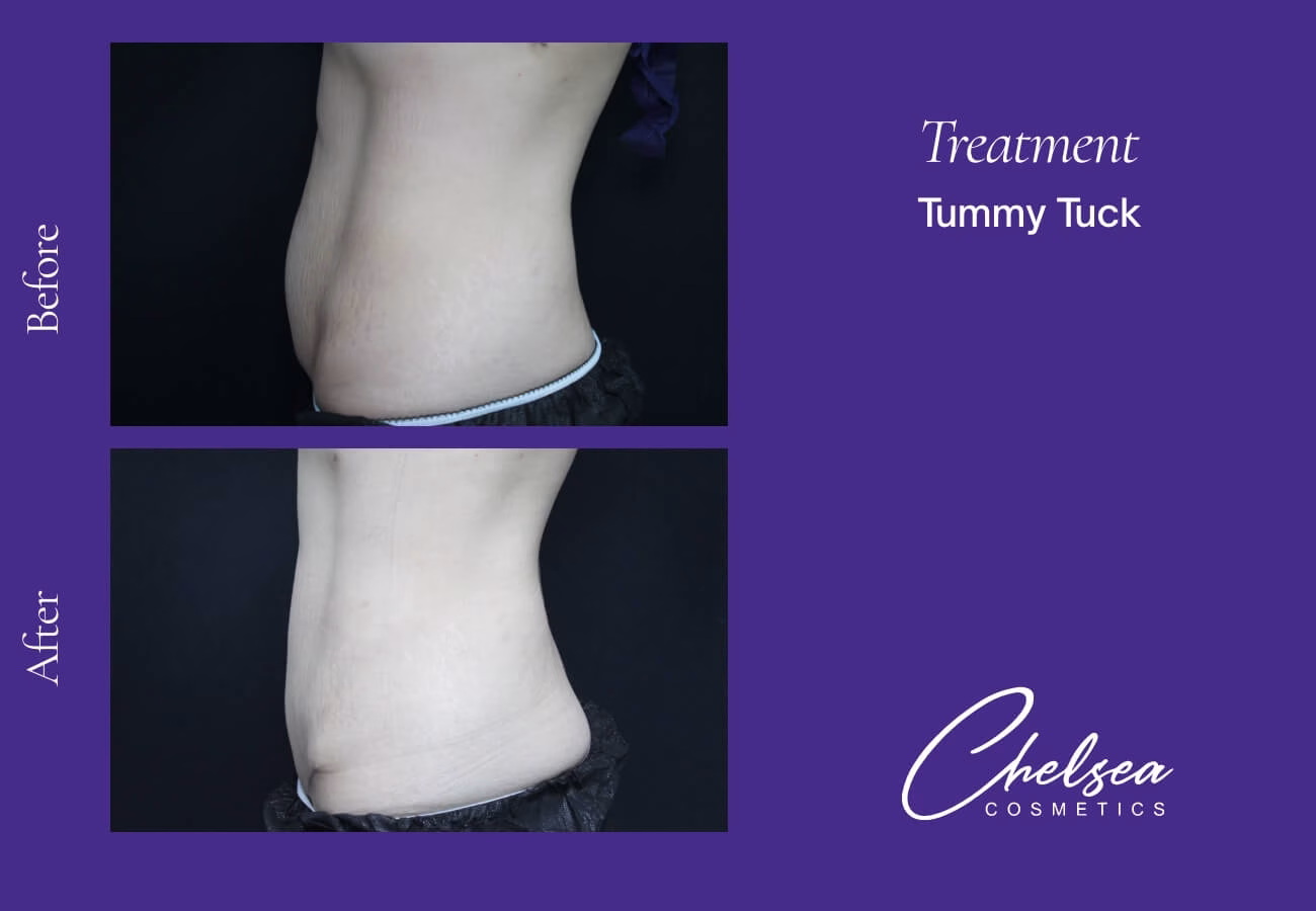 Tummy Tuck (Abdominoplasty) — Chelsea Cosmetics Melbourne