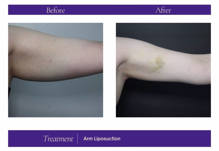 Arm Liposuction — Chelsea Cosmetics Melbourne