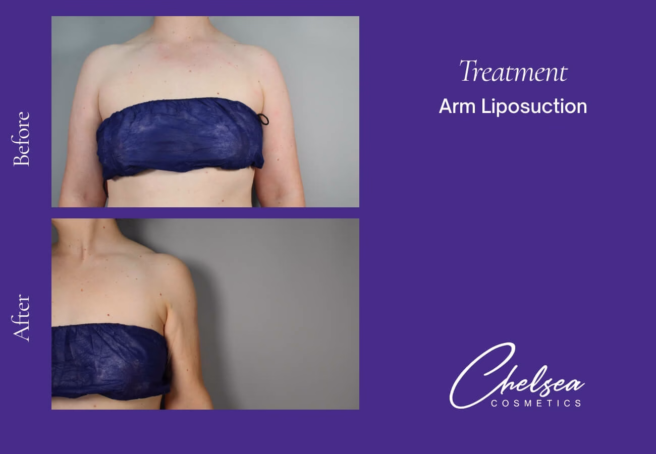 Liposuction — Chelsea Cosmetics Melbourne