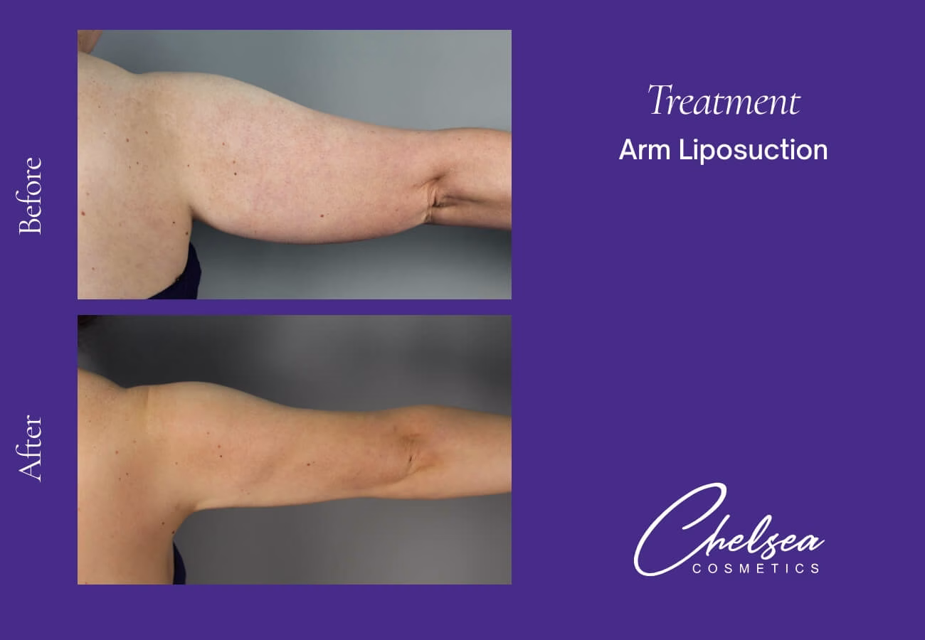 Liposuction — Chelsea Cosmetics Melbourne