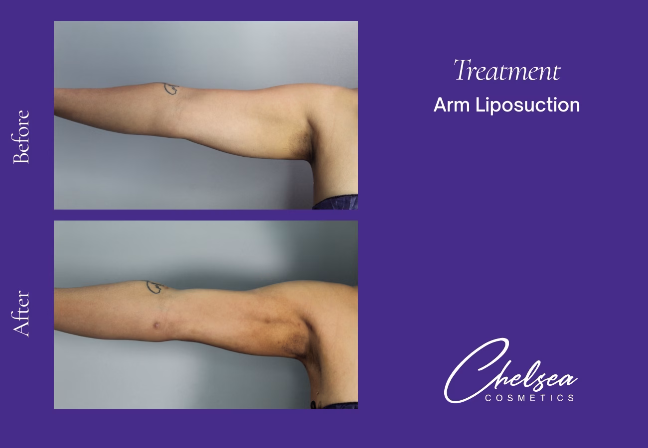 Liposuction — Chelsea Cosmetics Melbourne