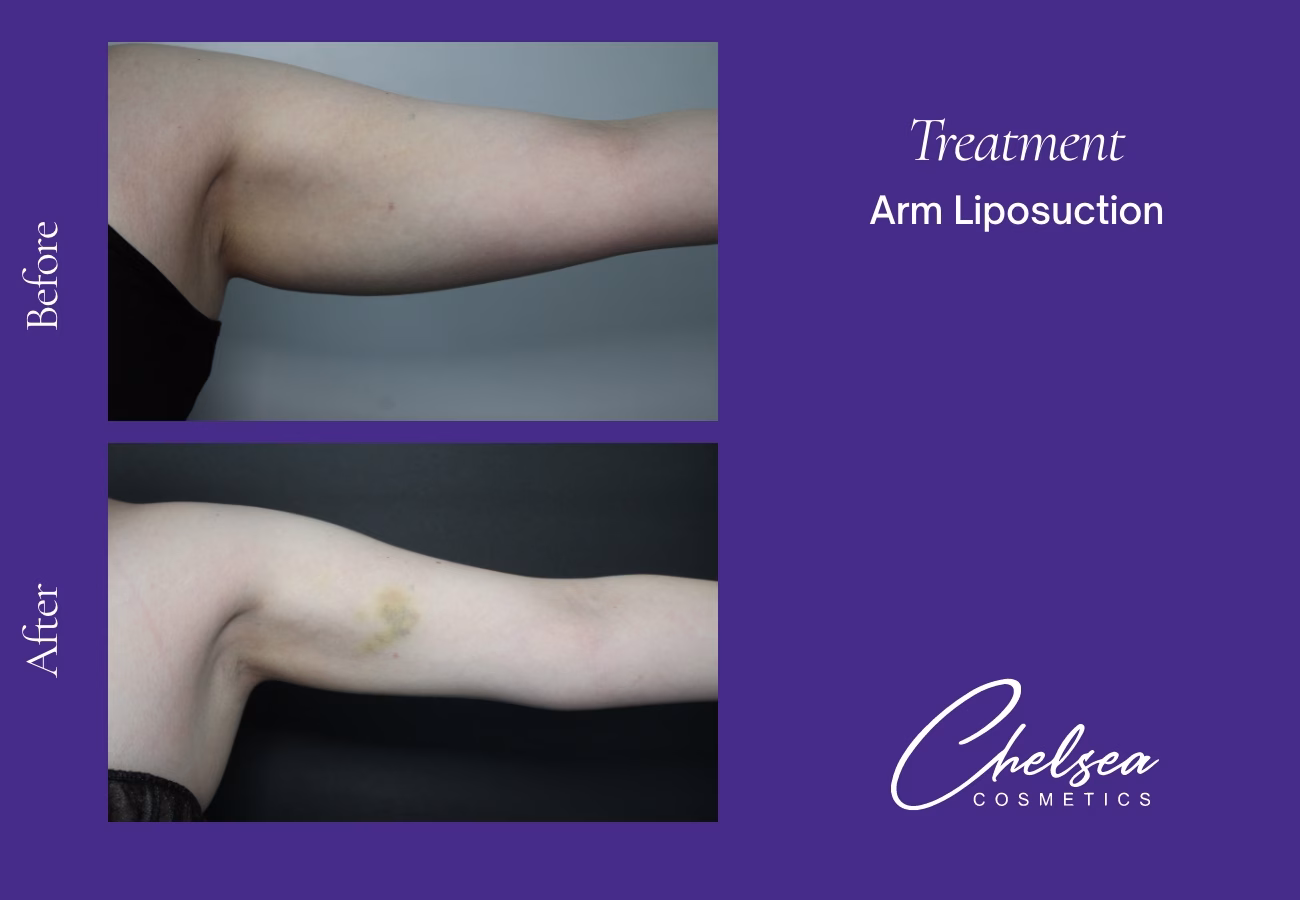 Liposuction — Chelsea Cosmetics Melbourne