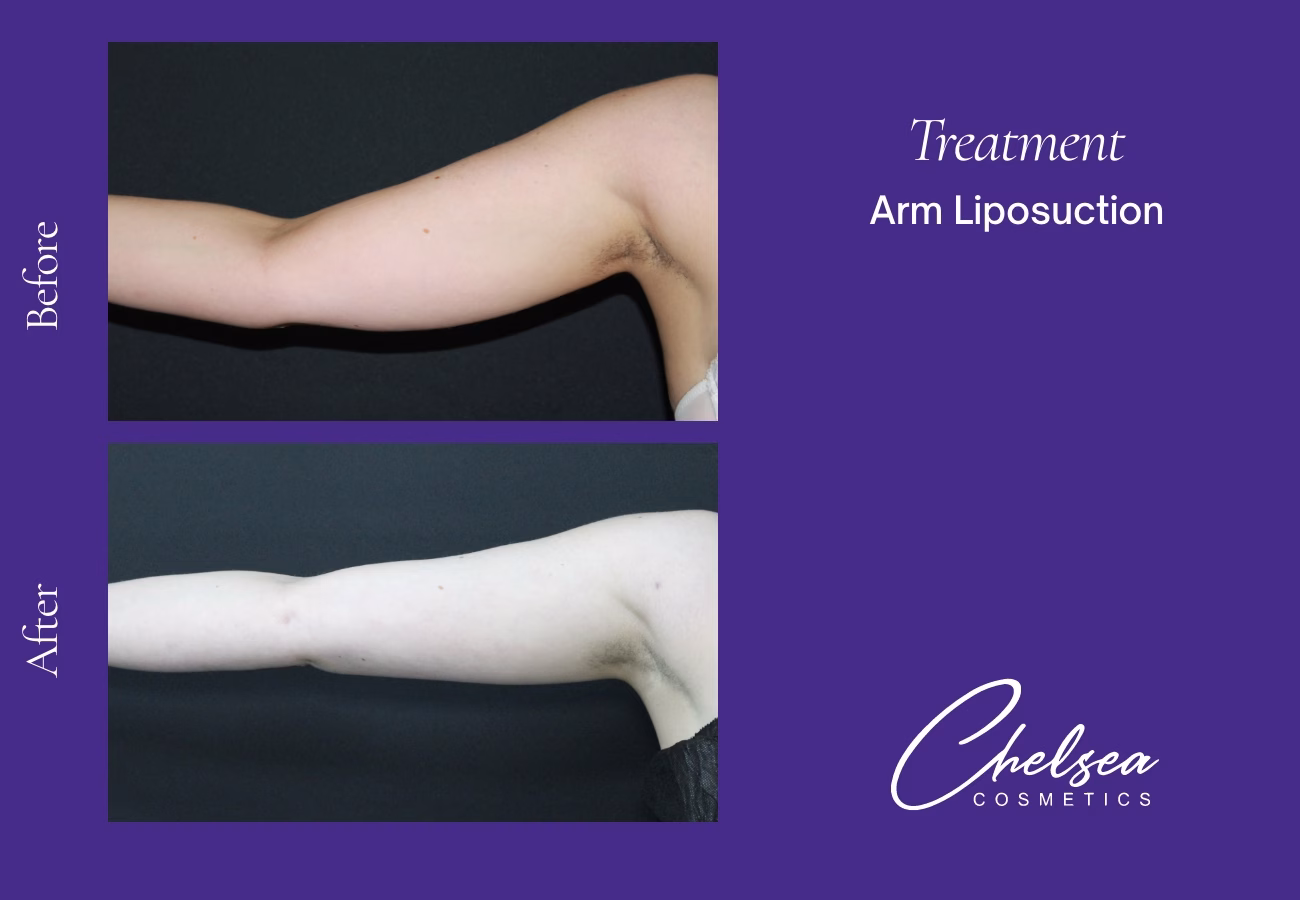 Liposuction — Chelsea Cosmetics Melbourne