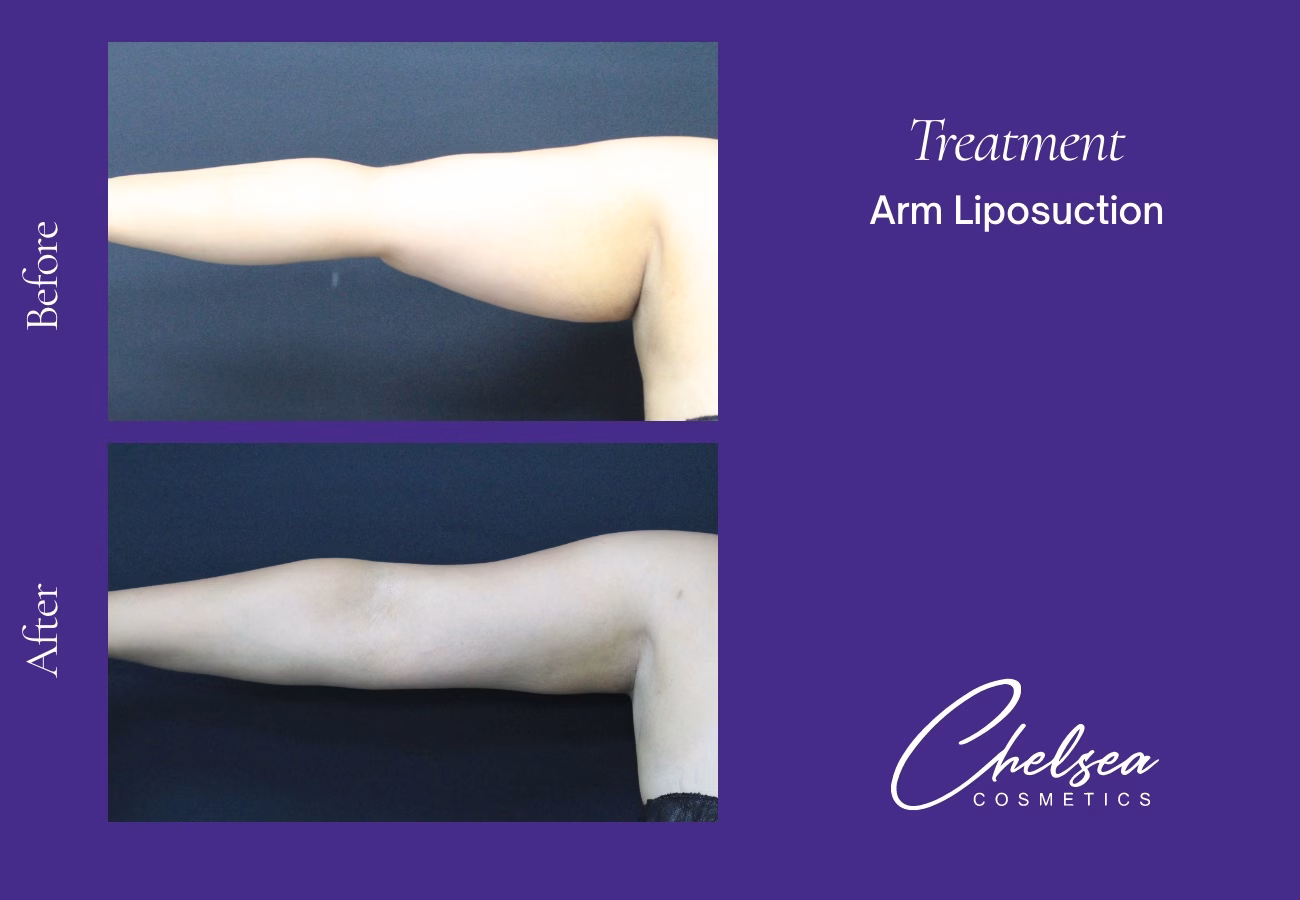 Liposuction — Chelsea Cosmetics Melbourne