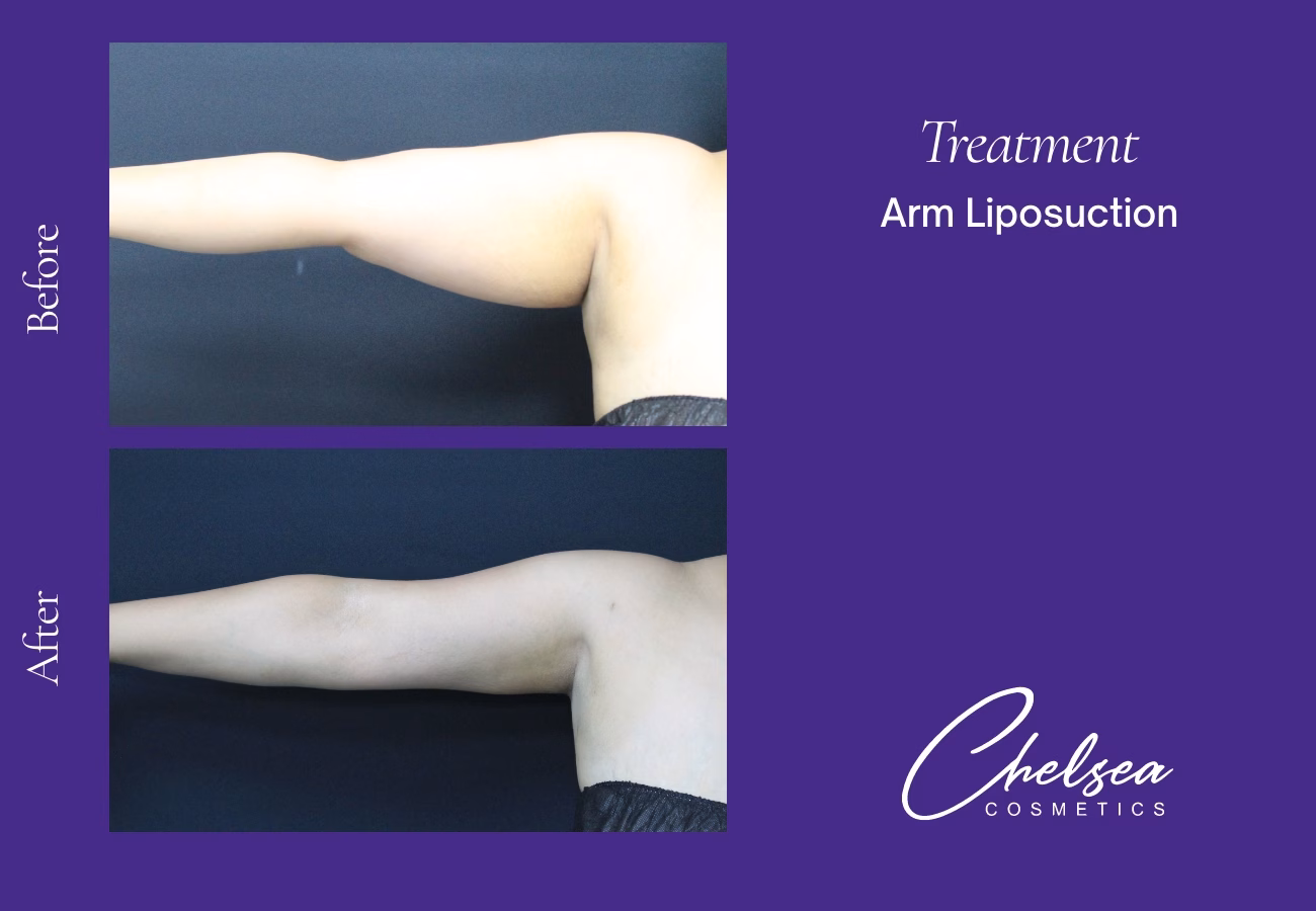 Liposuction — Chelsea Cosmetics Melbourne