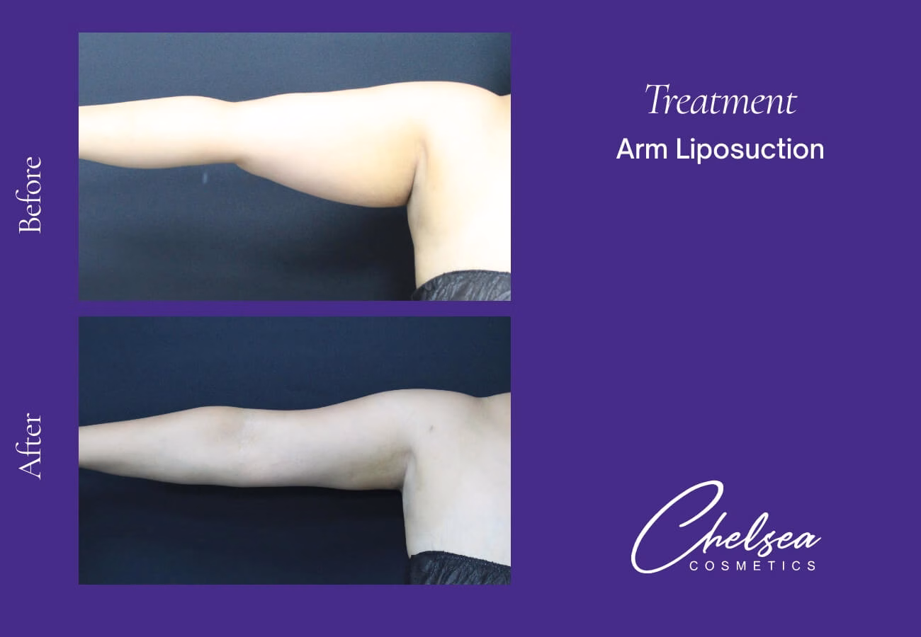 Liposuction — Chelsea Cosmetics Melbourne