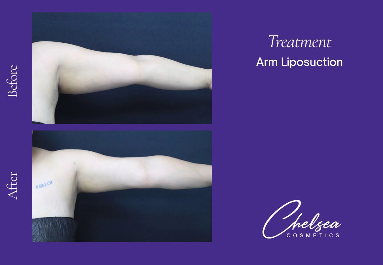 Liposuction — Chelsea Cosmetics Melbourne