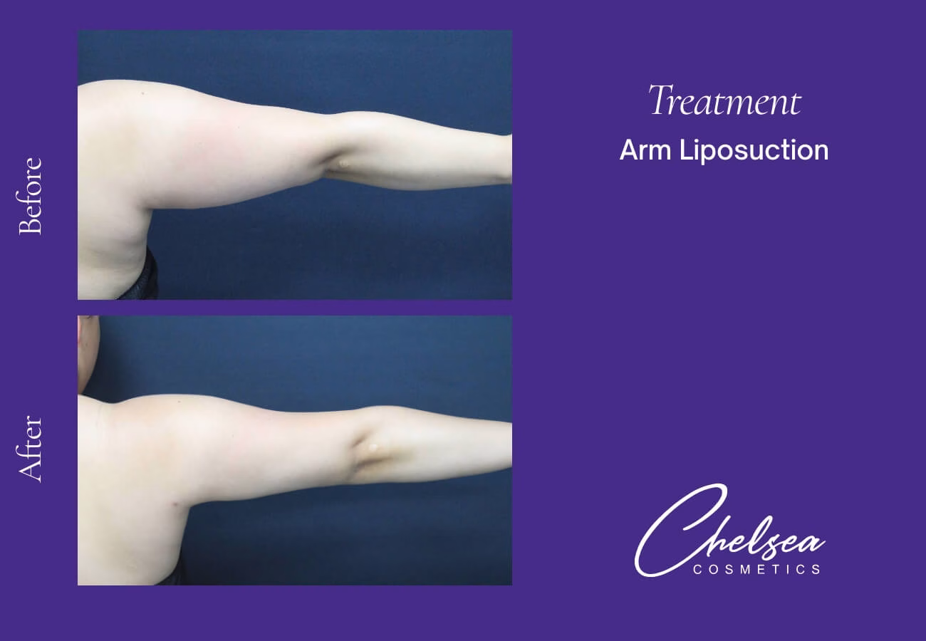 Liposuction — Chelsea Cosmetics Melbourne