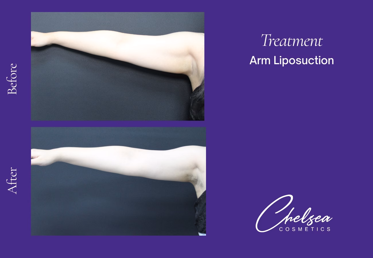 Liposuction — Chelsea Cosmetics Melbourne