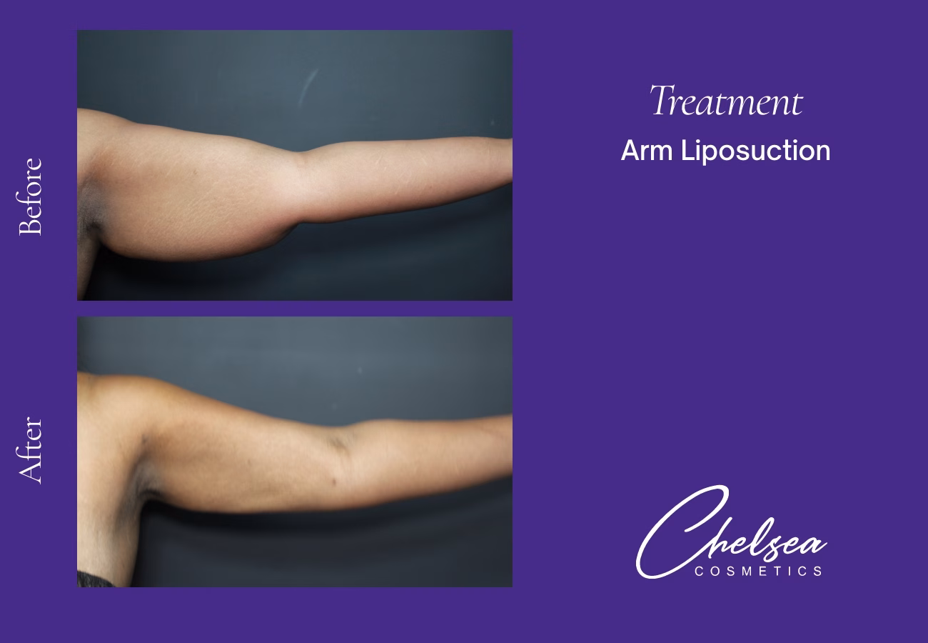 Liposuction — Chelsea Cosmetics Melbourne