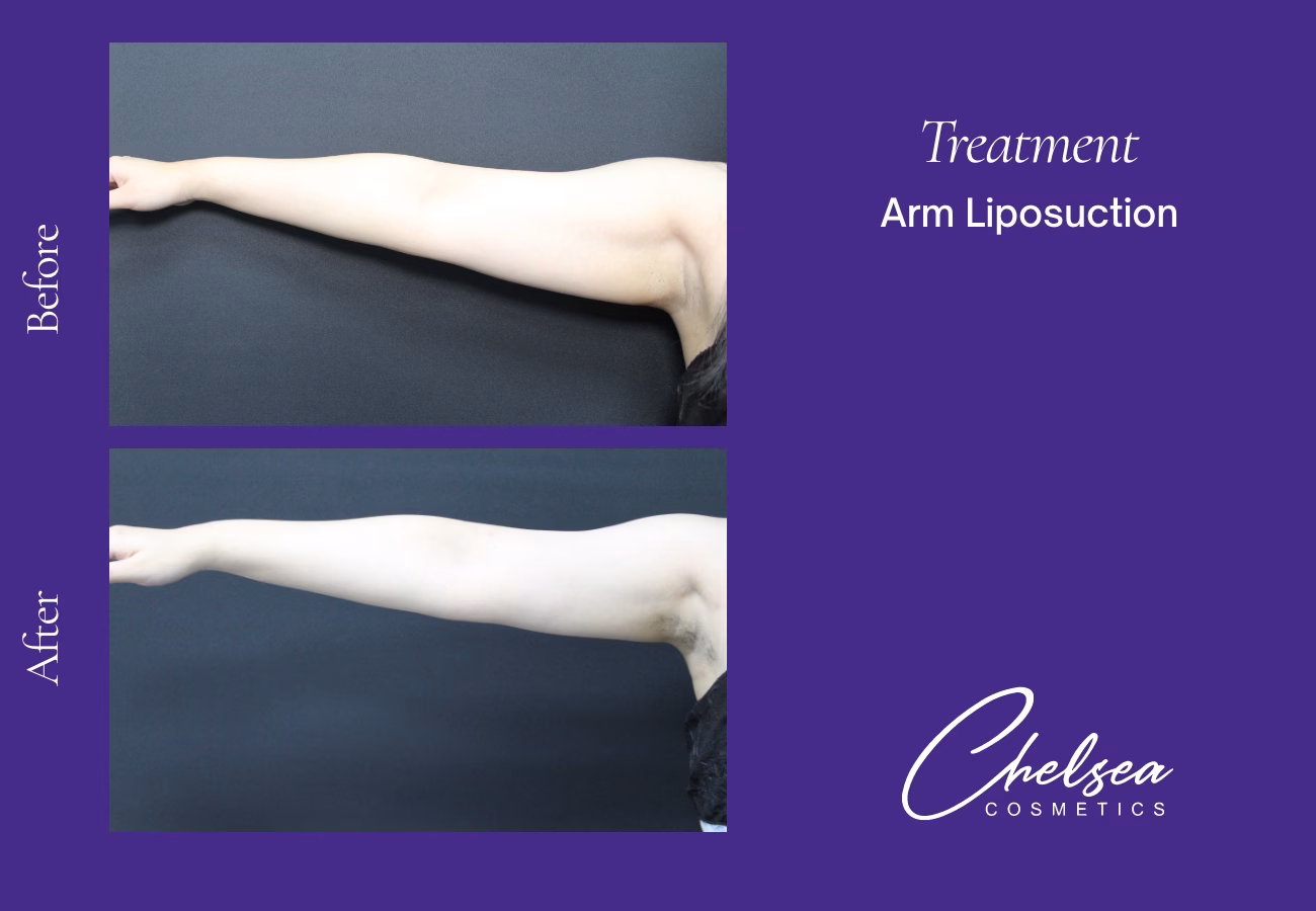 Liposuction — Chelsea Cosmetics Melbourne