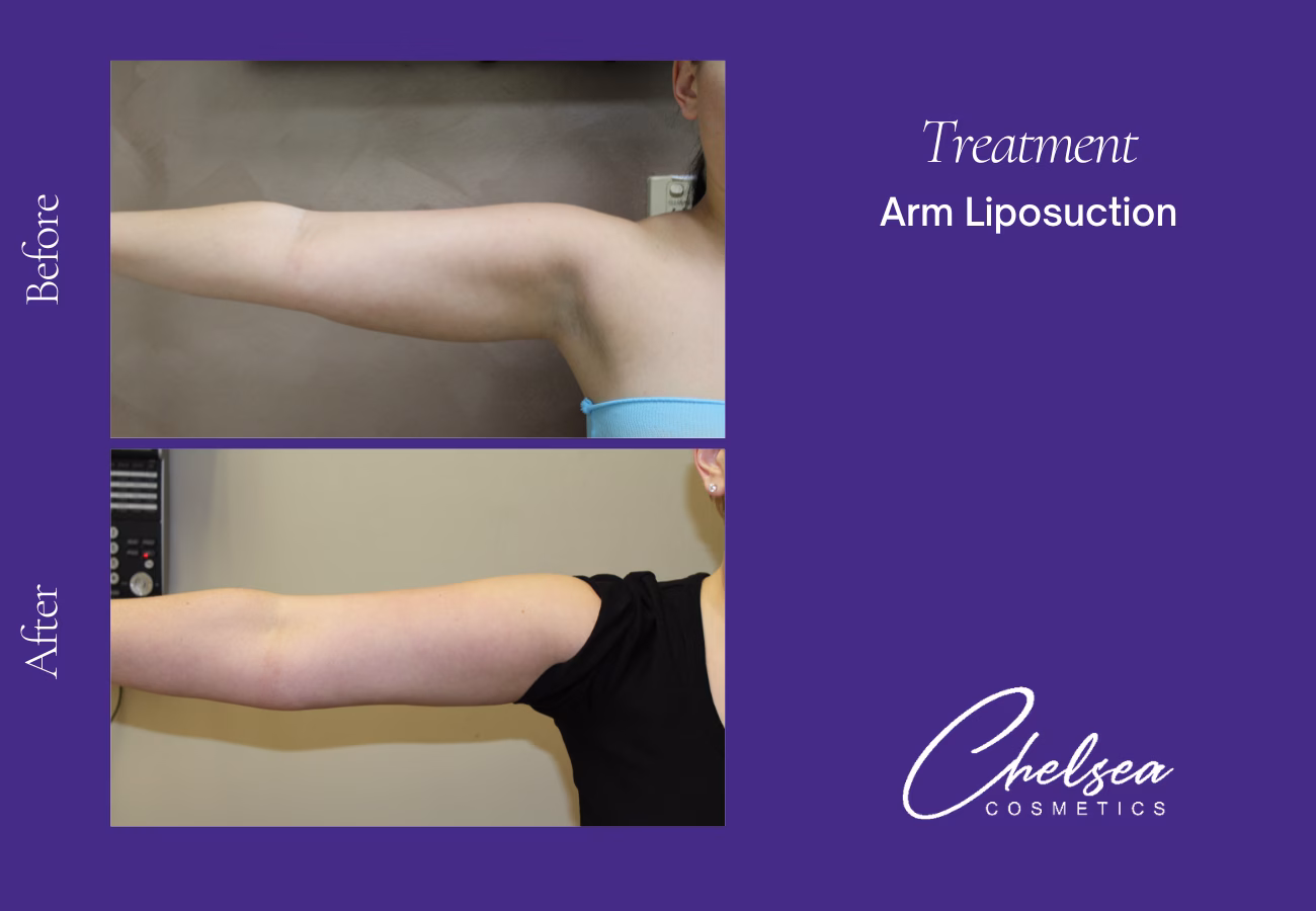 Liposuction — Chelsea Cosmetics Melbourne