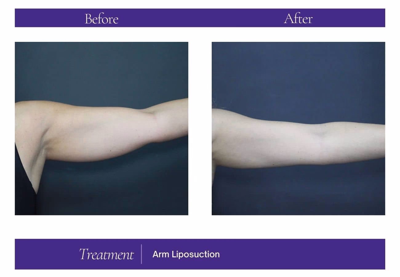 Liposuction — Chelsea Cosmetics Melbourne