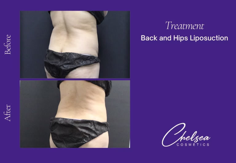 Liposuction before and after results — Chelsea Cosmetics Melbourne