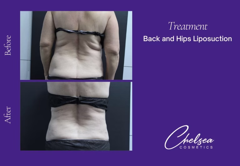 Liposuction before and after results — Chelsea Cosmetics Melbourne