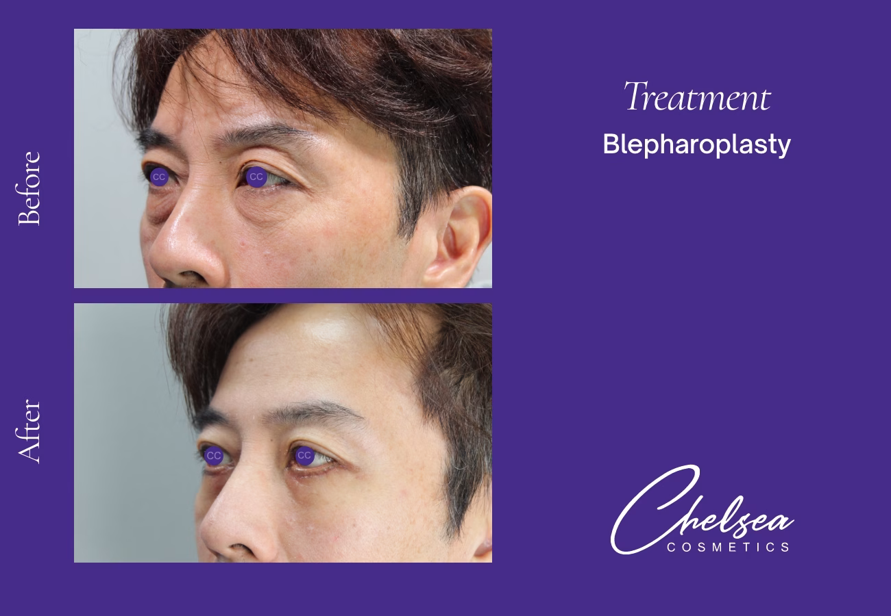 Eyelid Surgery — Chelsea Cosmetics Melbourne