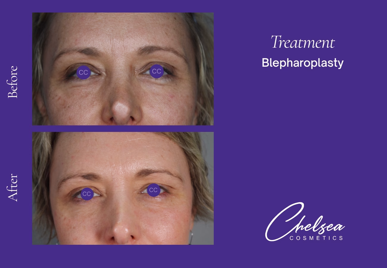 Eyelid Surgery — Chelsea Cosmetics Melbourne