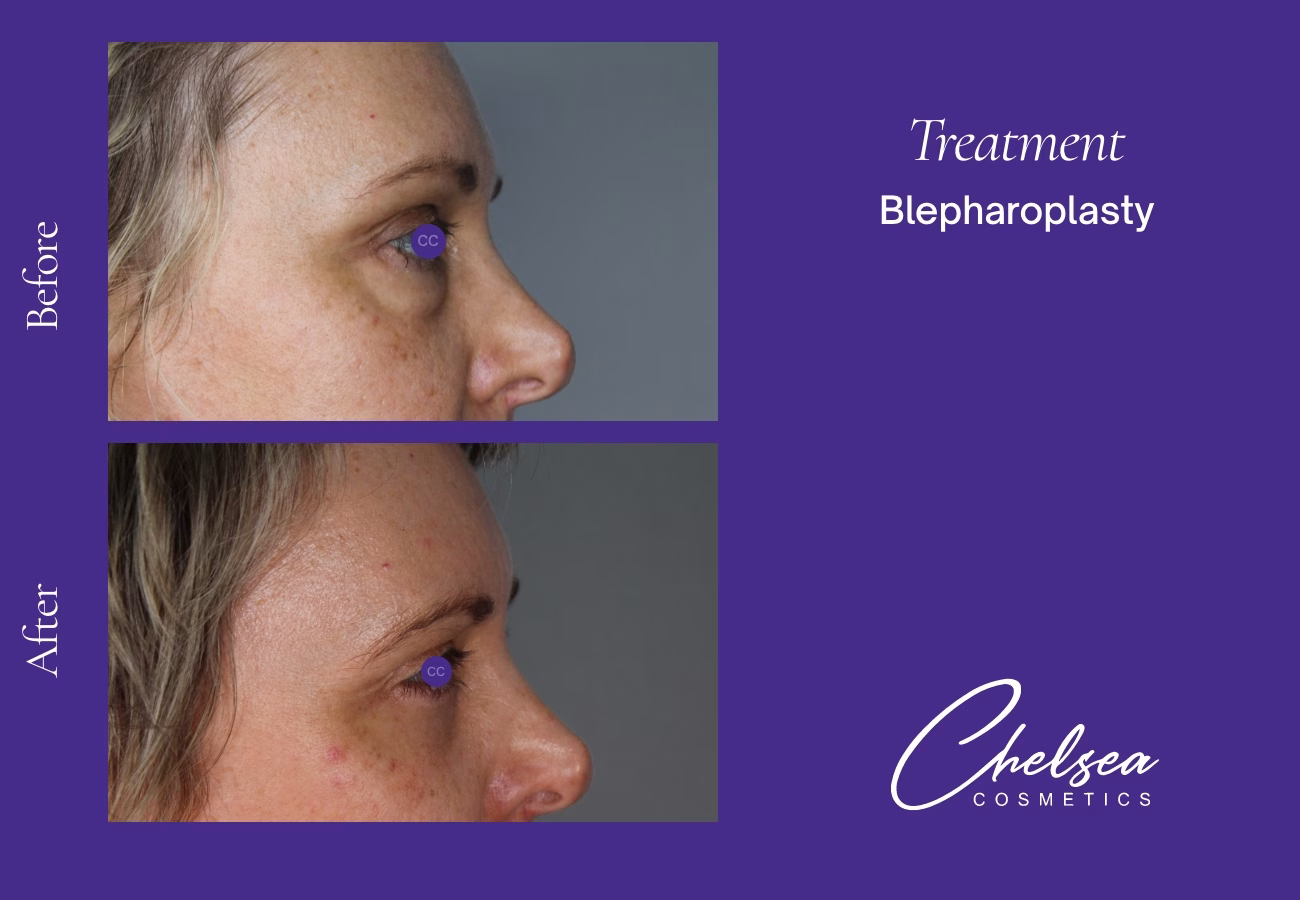 Eyelid Surgery — Chelsea Cosmetics Melbourne