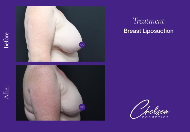 Eyelid Surgery — Chelsea Cosmetics Melbourne