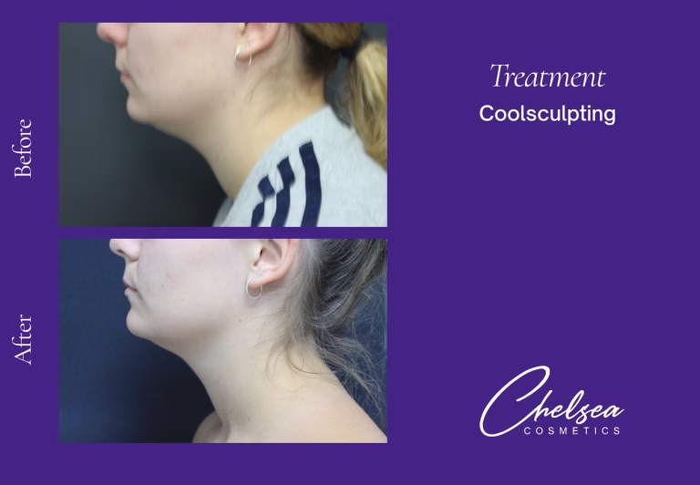 Coolsculpting