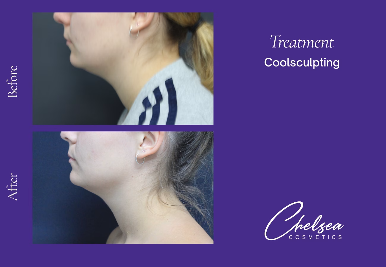 Eyelid Surgery — Chelsea Cosmetics Melbourne