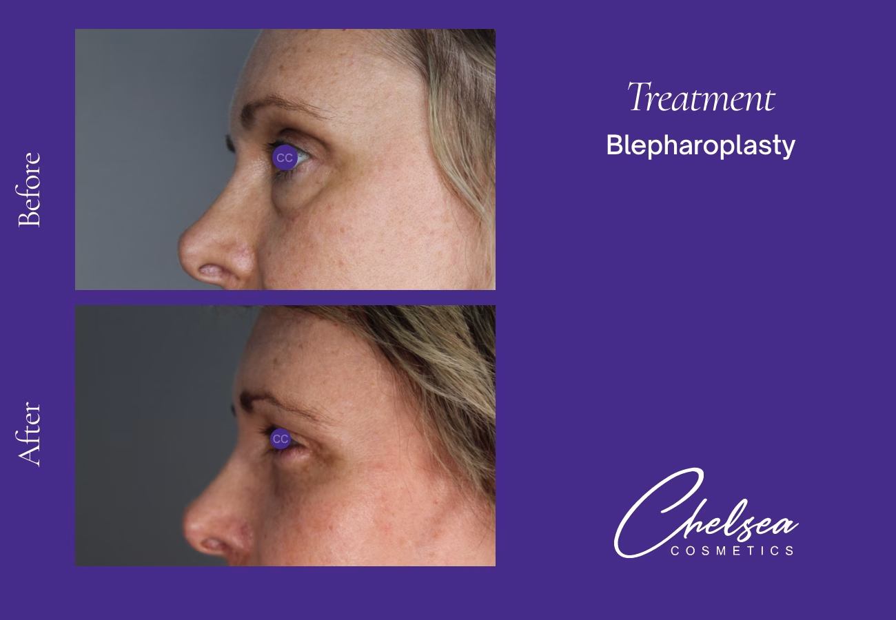 Eyelid Surgery — Chelsea Cosmetics Melbourne