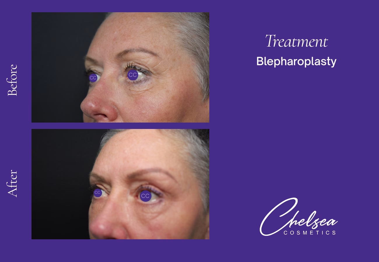 Eyelid Surgery — Chelsea Cosmetics Melbourne