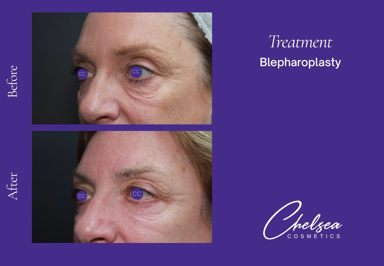 Eyelid Surgery — Chelsea Cosmetics Melbourne