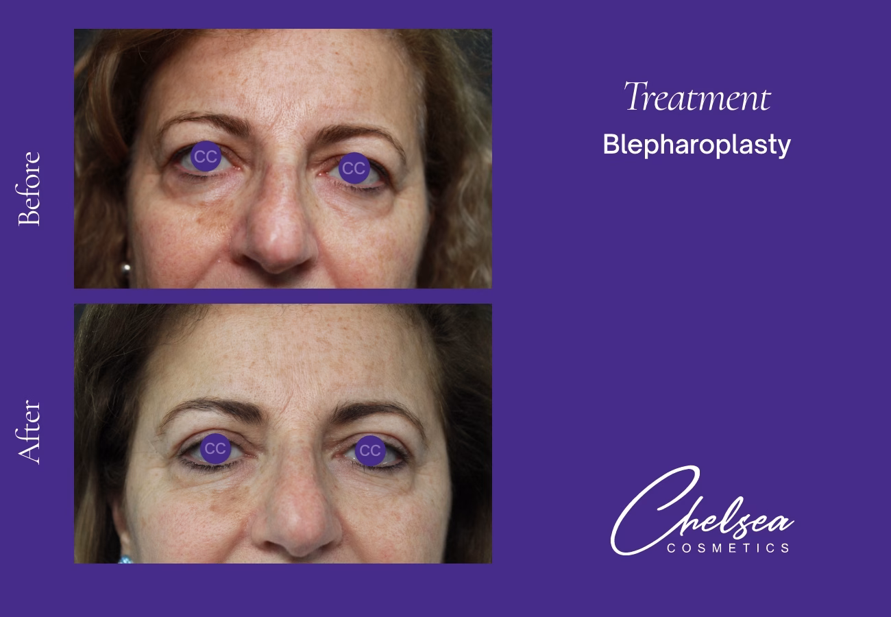 Eyelid Surgery — Chelsea Cosmetics Melbourne
