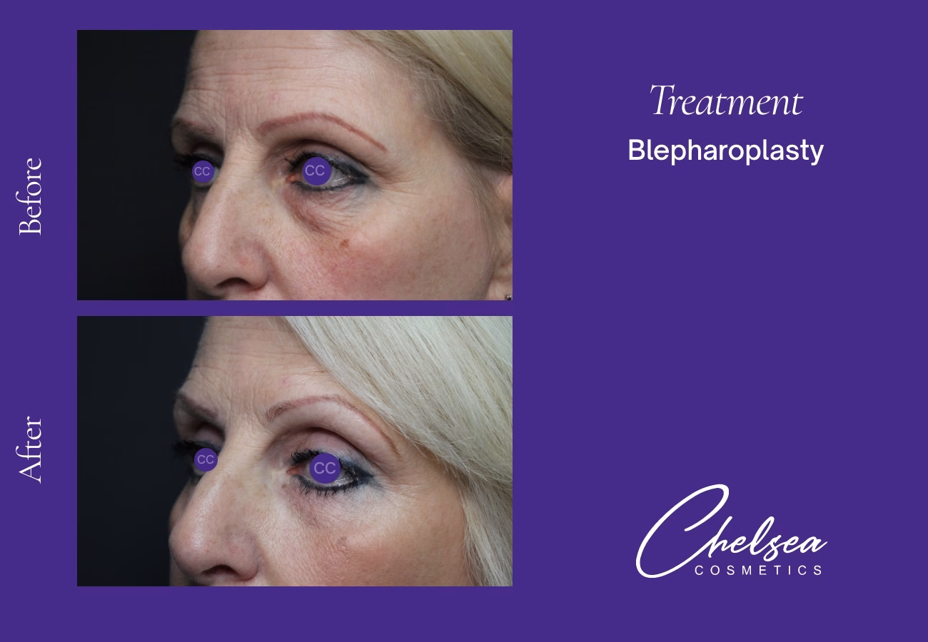 Eyelid Surgery — Chelsea Cosmetics Melbourne