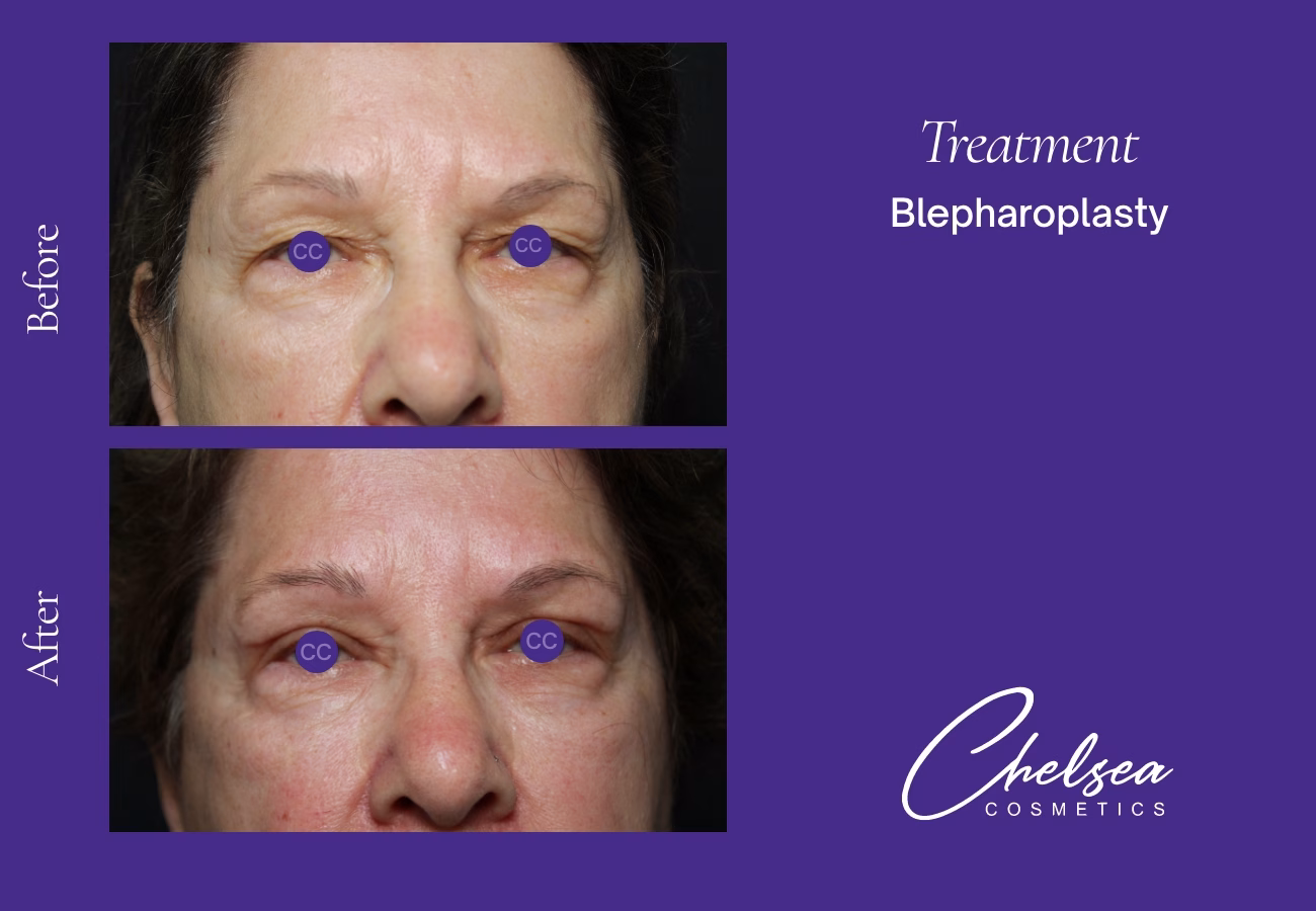 Eyelid Surgery — Chelsea Cosmetics Melbourne