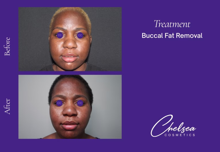 Buccal Fat Removal