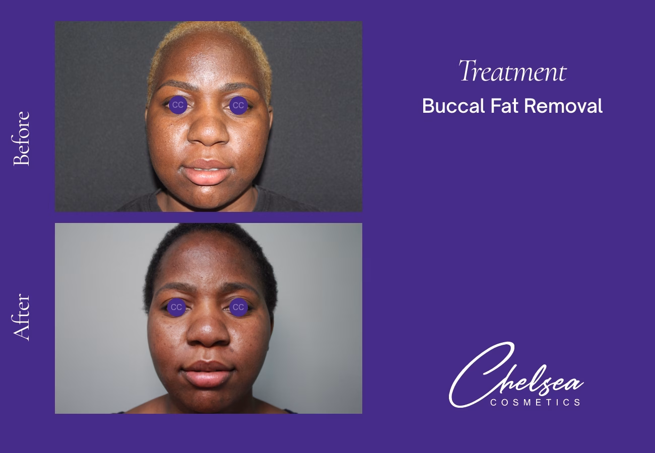 Buccal Fat Removal — Chelsea Cosmetics Melbourne