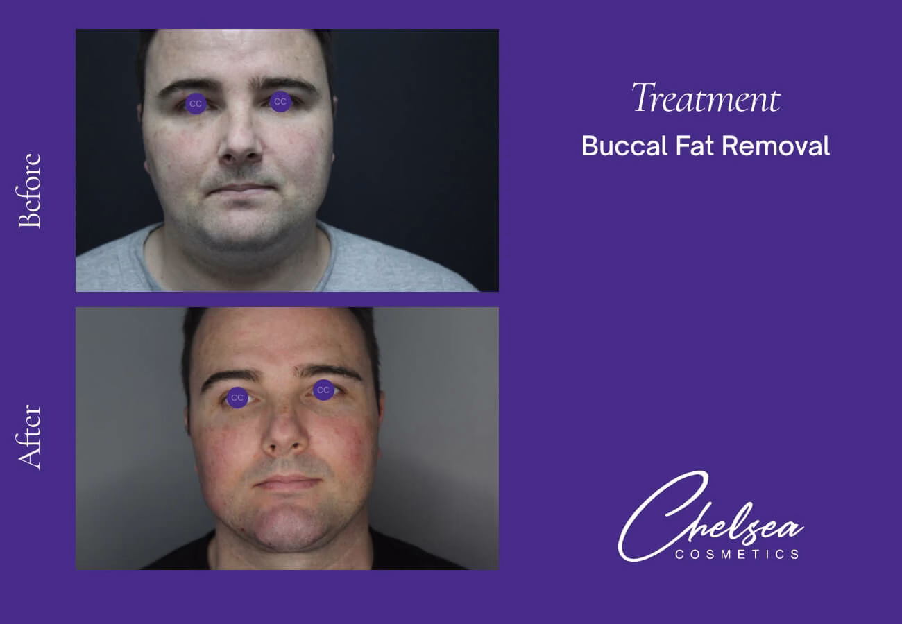 Buccal Fat Removal — Chelsea Cosmetics Melbourne