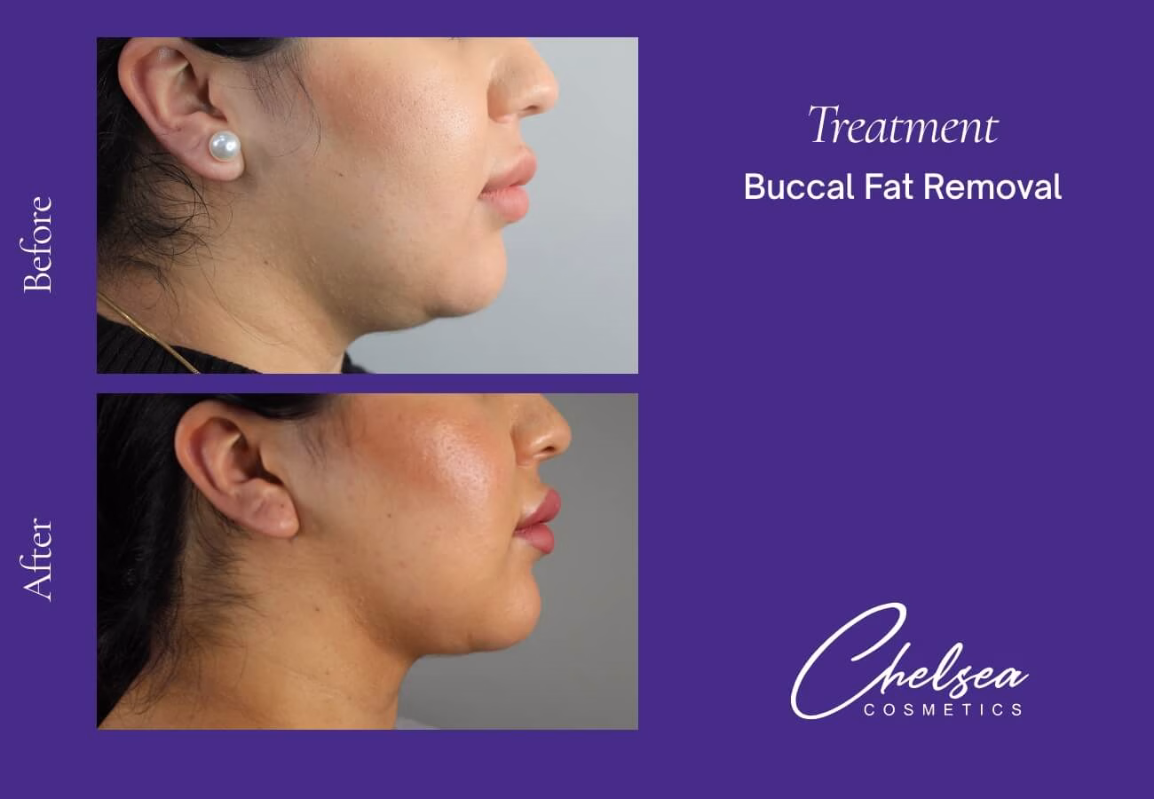 Buccal Fat Removal — Chelsea Cosmetics Melbourne