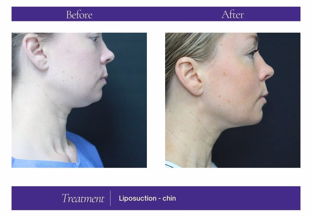 Chin Treatment — Chelsea Cosmetics Melbourne