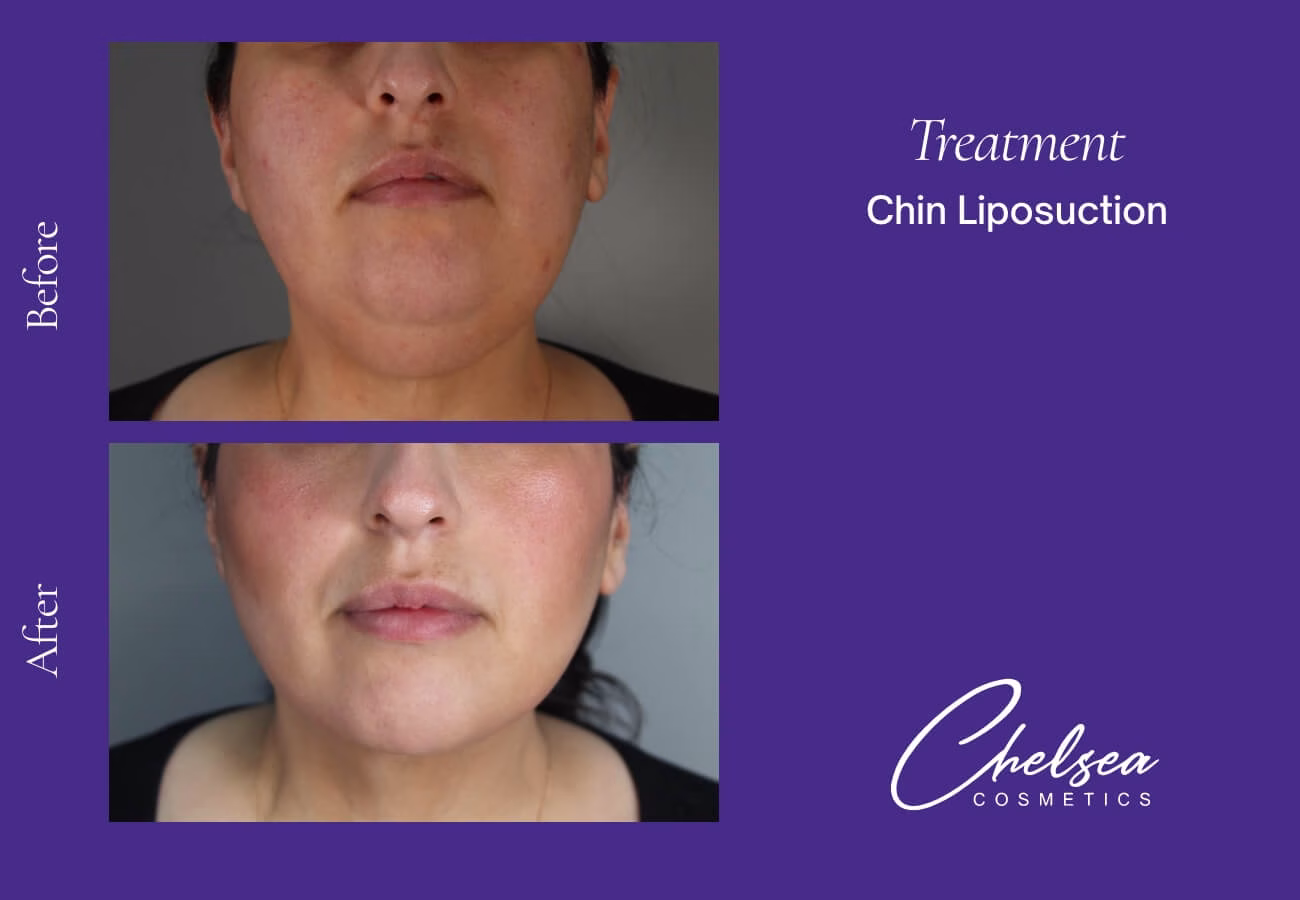 Liposuction — Chelsea Cosmetics Melbourne