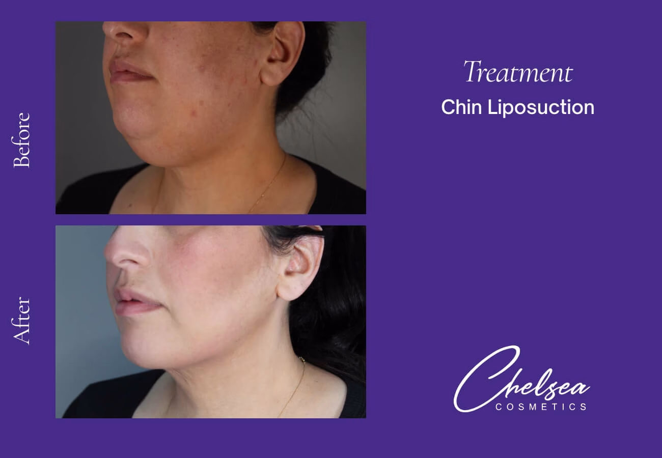 Liposuction — Chelsea Cosmetics Melbourne