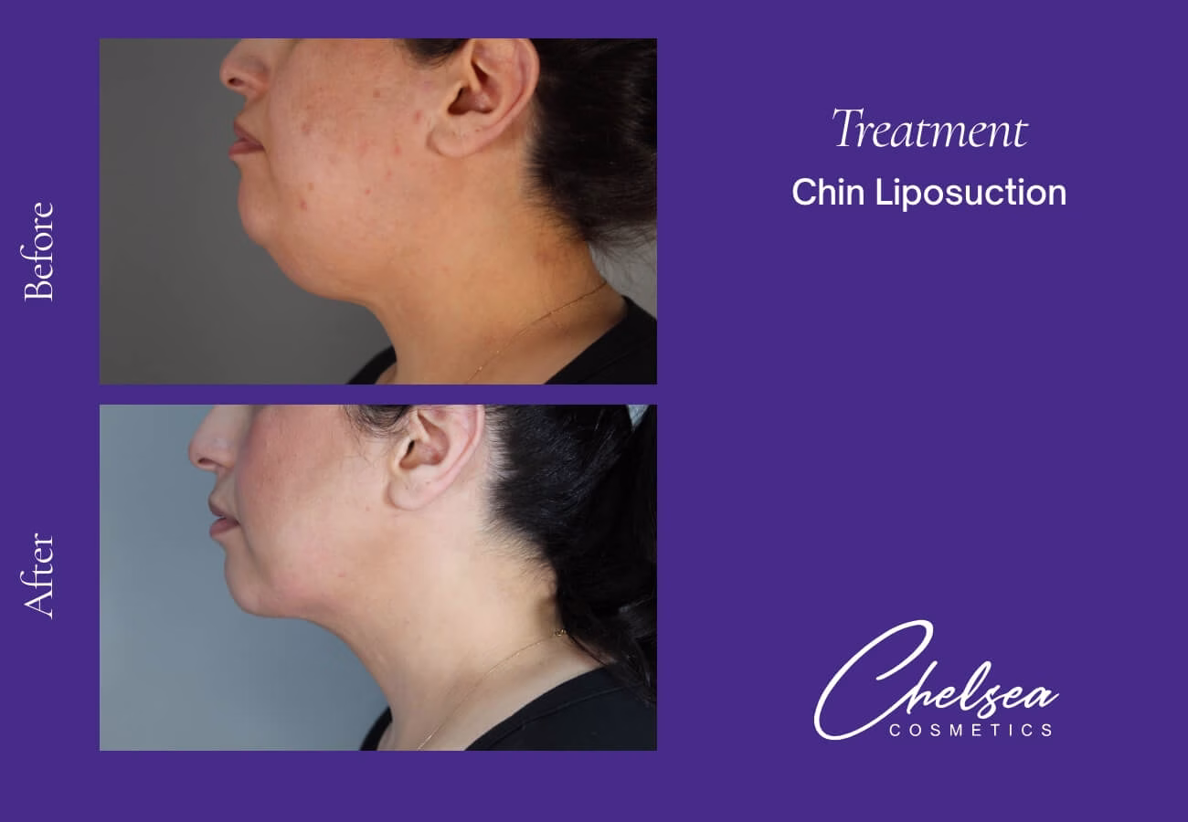 Liposuction — Chelsea Cosmetics Melbourne