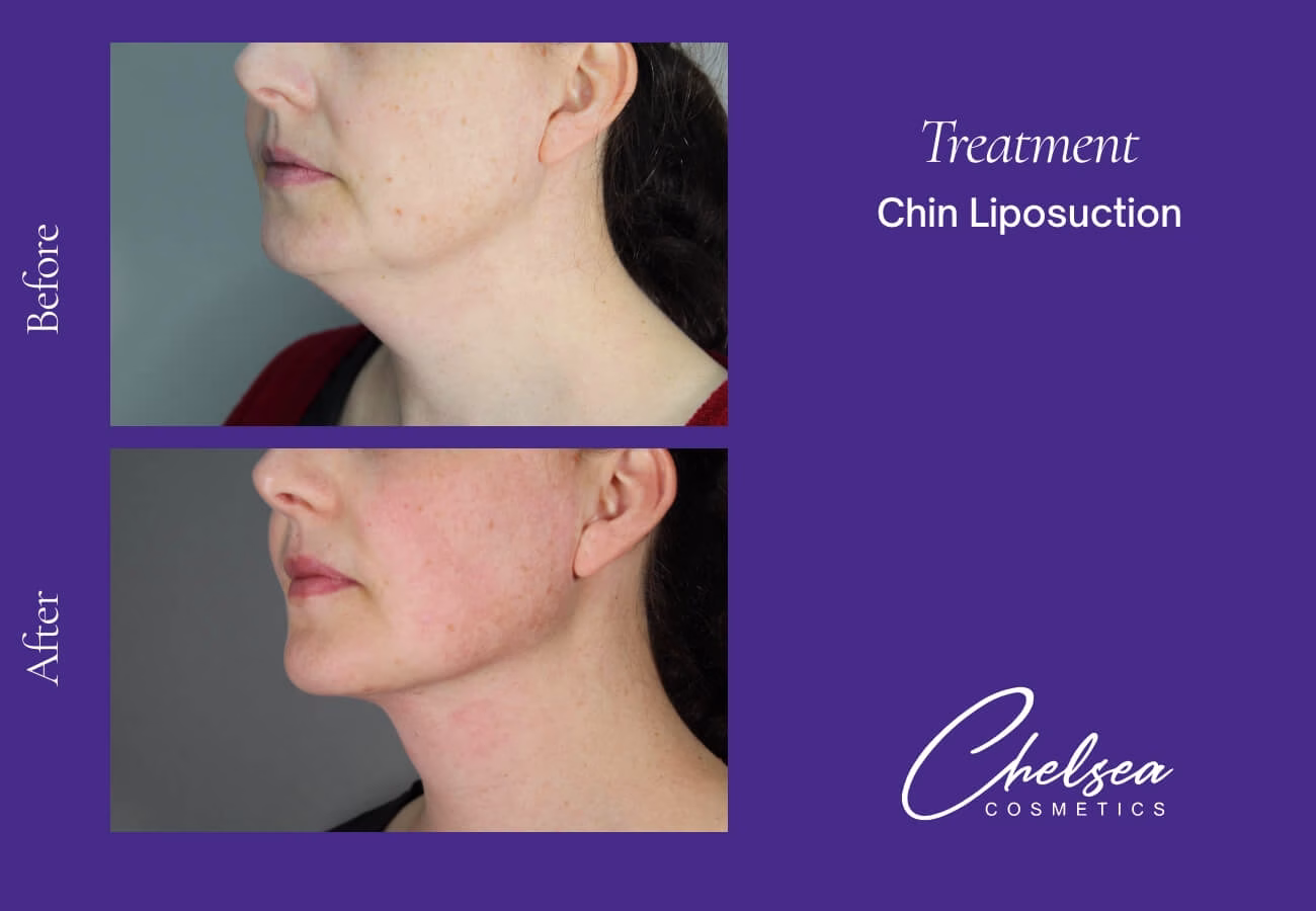 Liposuction — Chelsea Cosmetics Melbourne