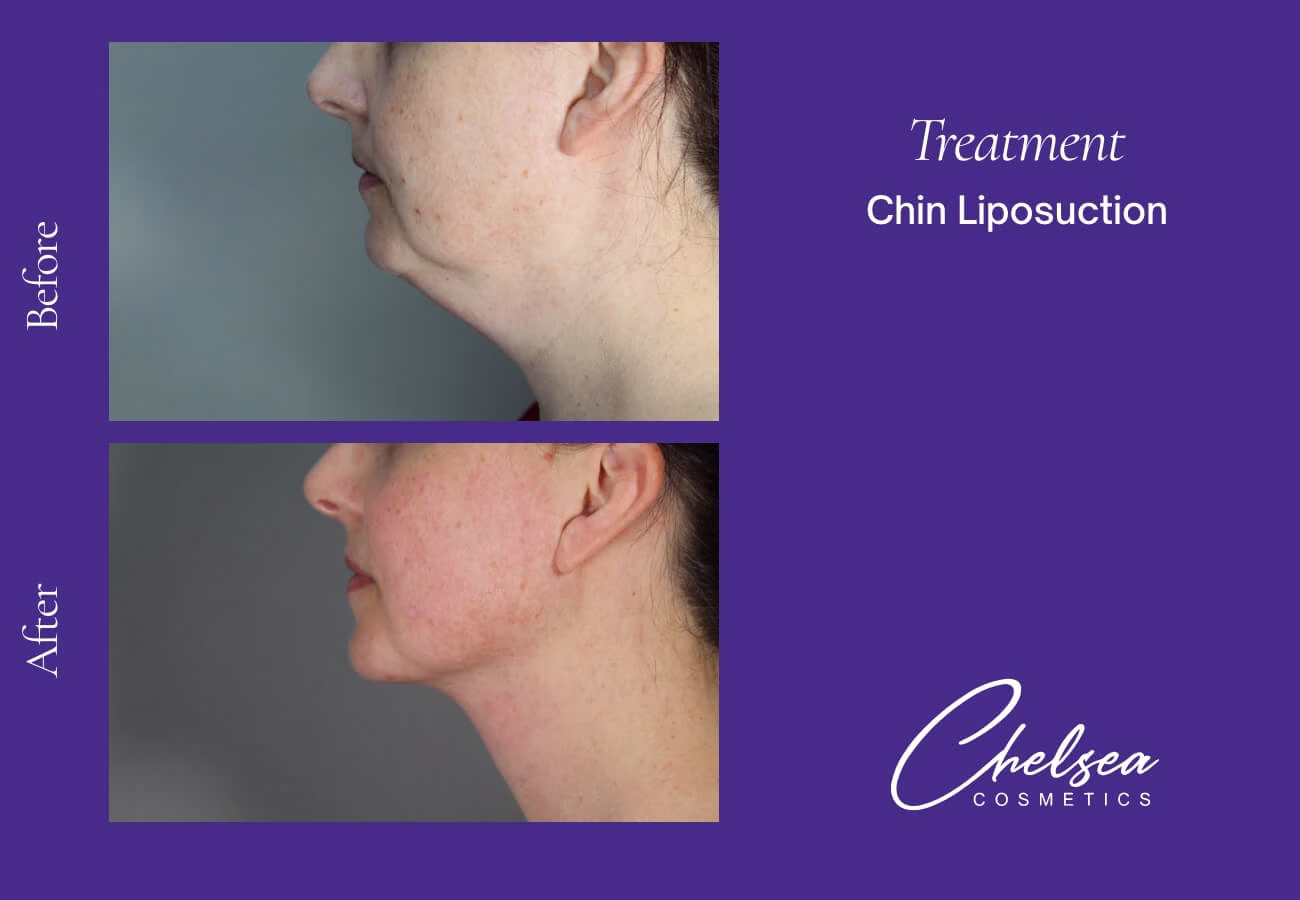 Liposuction — Chelsea Cosmetics Melbourne