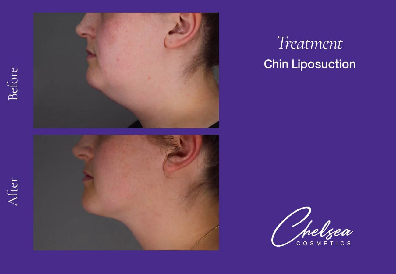 Liposuction — Chelsea Cosmetics Melbourne